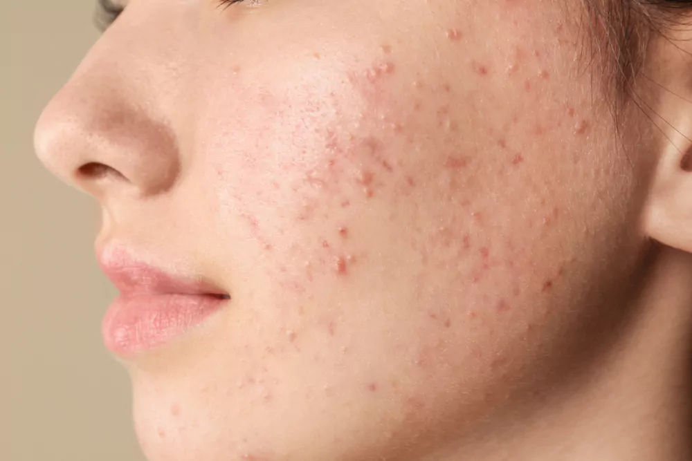 woman having acne