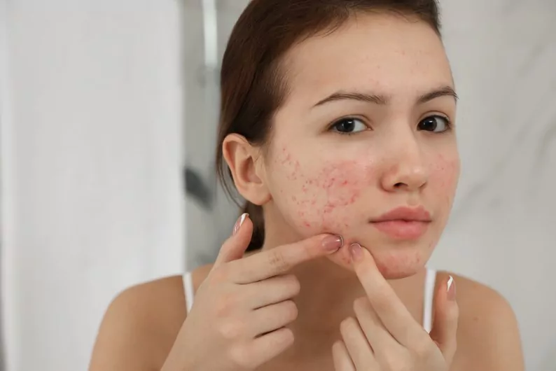 teen girl with acne problem squeezing pimple