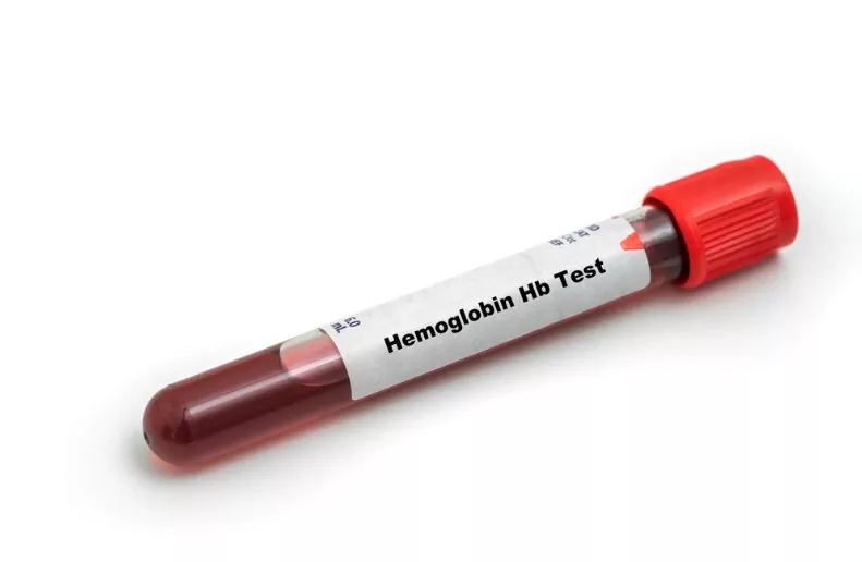 hemoglobin hb test medical check-up test tube with a biological sample