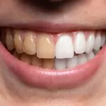 before and after view of teeth whitening