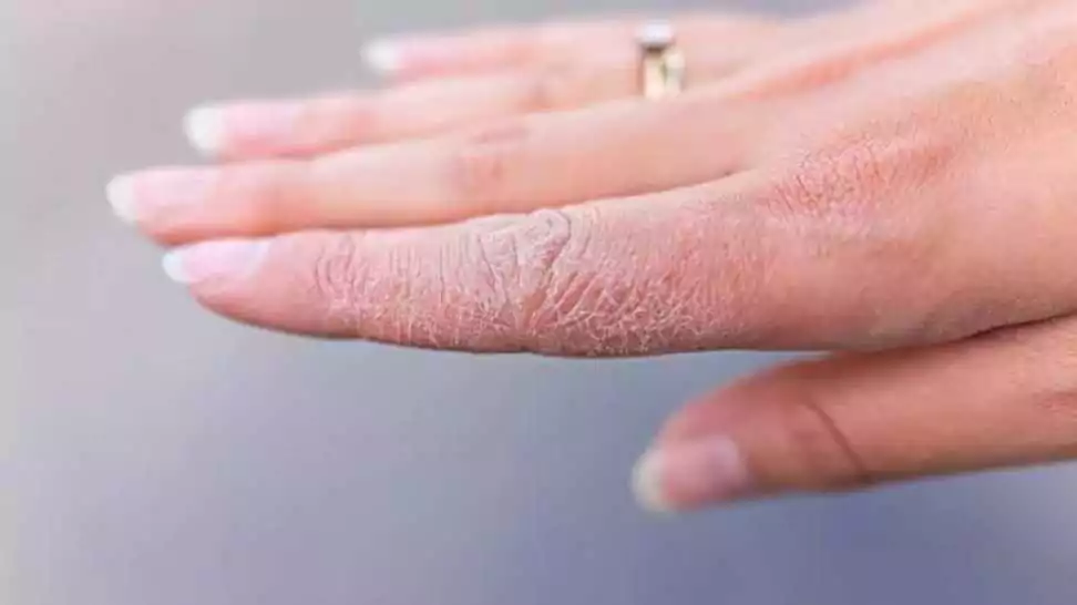 peeling off fevikvik from a woman's hand