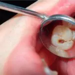 a dental tooth decay cavity found during routine dental examination