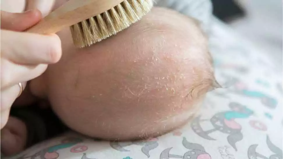 parent brushing head of a child because of a cradle cap