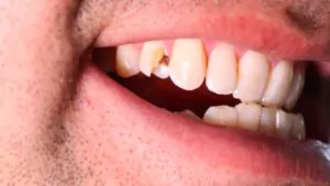 close up of a man with a cracked tooth
